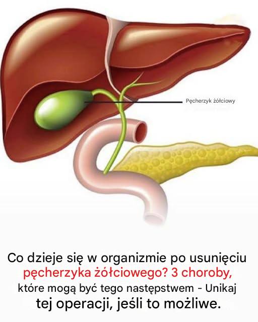 Co dzieje się w organizmie po usunięciu pęcherzyka żółciowego? 3 choroby, które mogą być tego konsekwencją